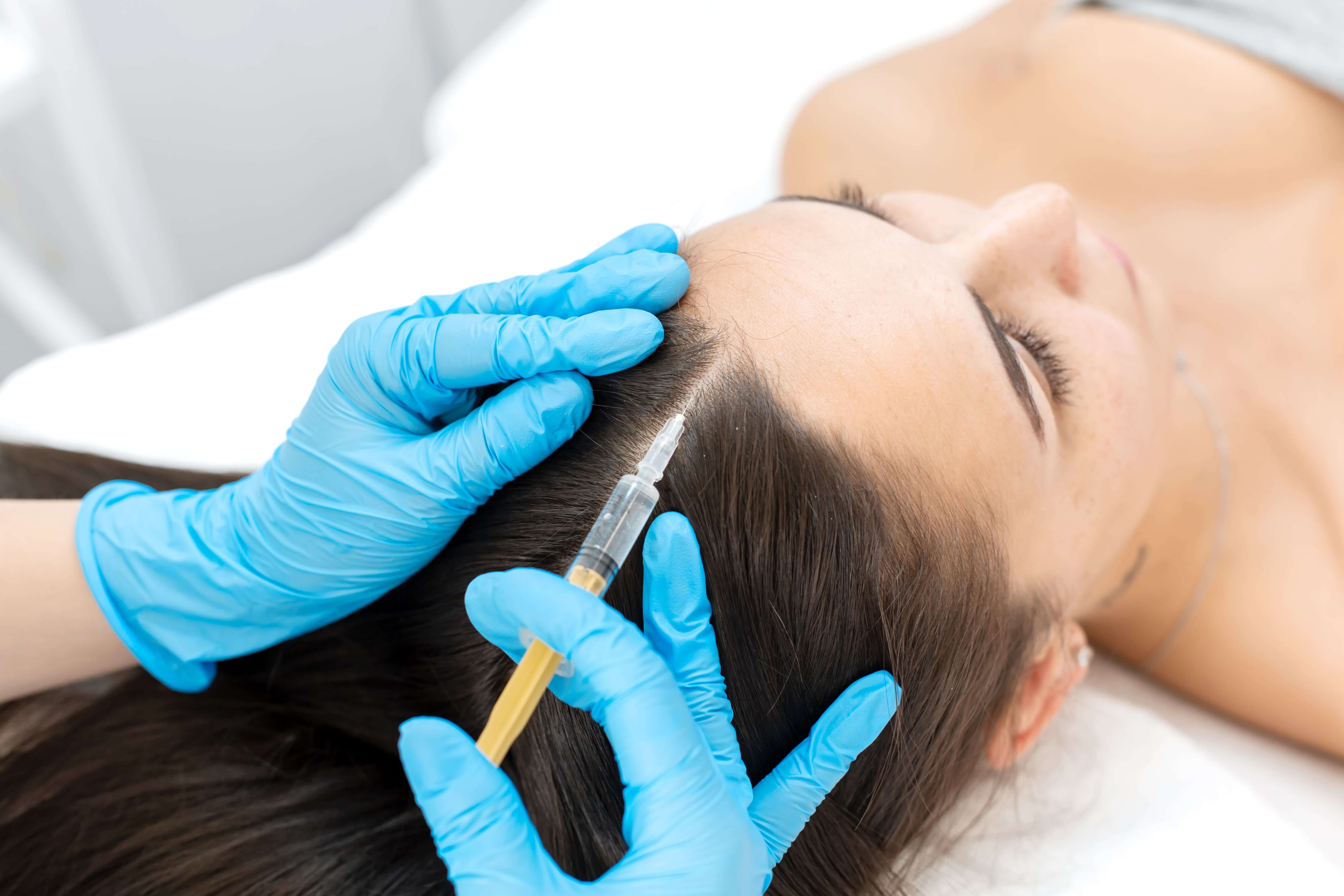 Everything You Need to Know About Mesotherapy for Hair Loss