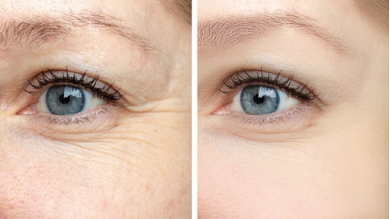 Mesotherapy to smooth out wrinkles and folds