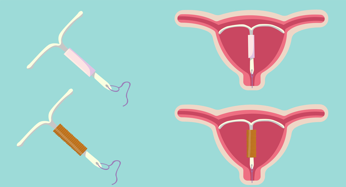 Liletta vs. Mirena: Exploring the Differences and Similarities