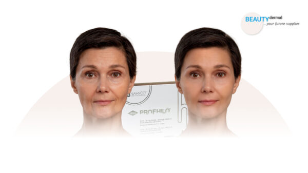 Profhilo Before And After: See The Dramatic Results