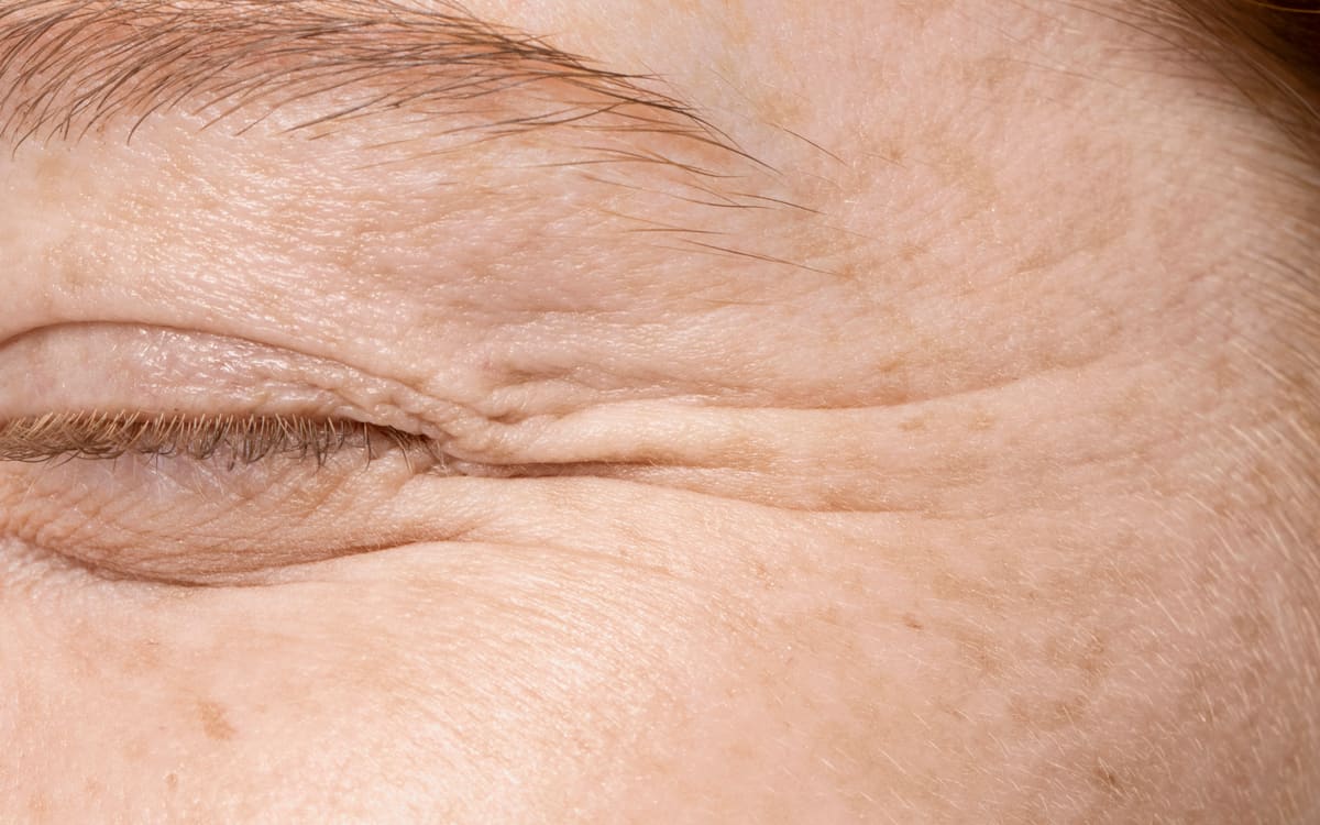 Reduction of mild wrinkles
