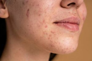 Confident young woman with acne close-up