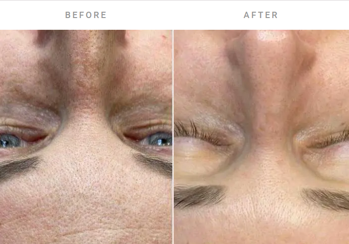 Biorepeel for fine lines before and after