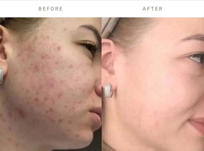 biorepeel for post acne scars before and after