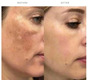 biorepeel for skin discoloration