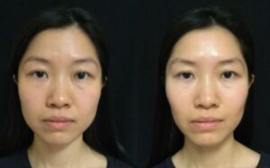 Botox for Masseter muscles 2 weeks before and after