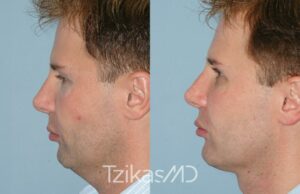 sculptra male for jawline before and after