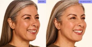 full face botox before and after 1