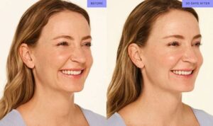full face botox before and after 2