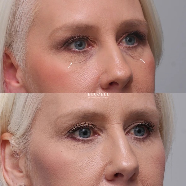 pdo thread lift under eyes before and after 1