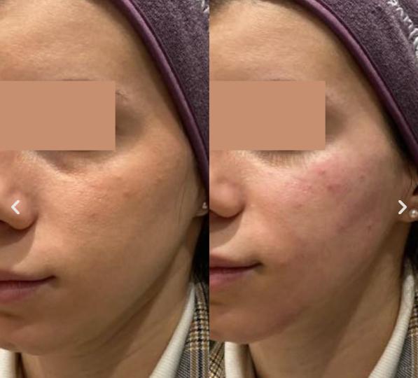 harmonyca before and after 1