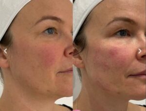 harmonyca before and after 2