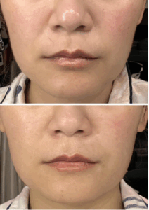pdo threads before and after photo 1